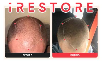 $500 off iRestore Professional Hair Growth Device